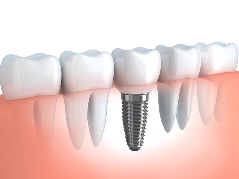 Dental Implants Serving Hillsborough, New Jersey
