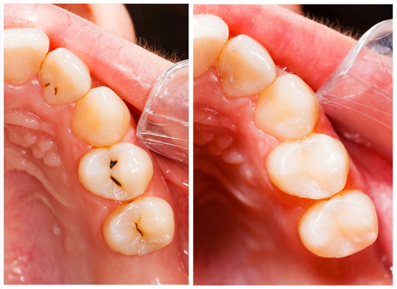 Fillings Serving Hillsborough, New Jersey