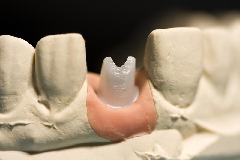 Implant Restoration Serving Hillsborough, New Jersey