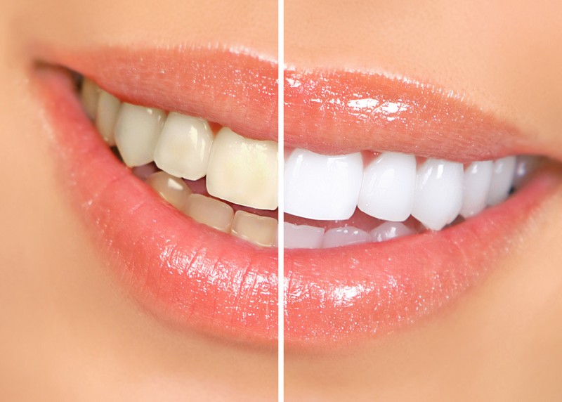 Teeth Whitening Serving Hillsborough, New Jersey